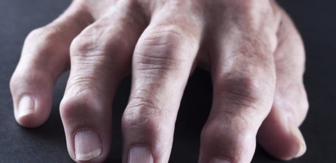 recomendaciones-cuidados-artritis