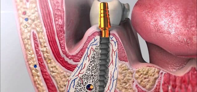 osteointegración