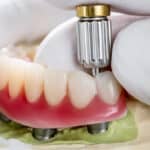 materiales implantes dentales