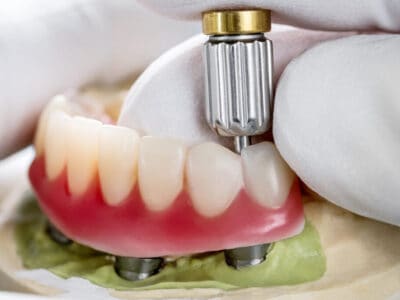 materiales implantes dentales