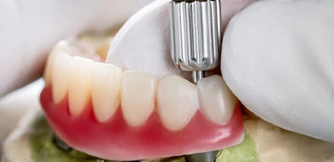 materiales implantes dentales